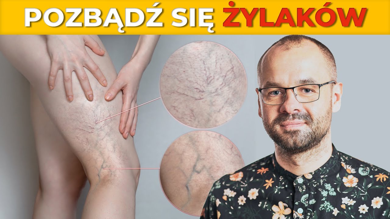 Jak skutecznie zapobiegać żylakom. | Marek Skoczylas