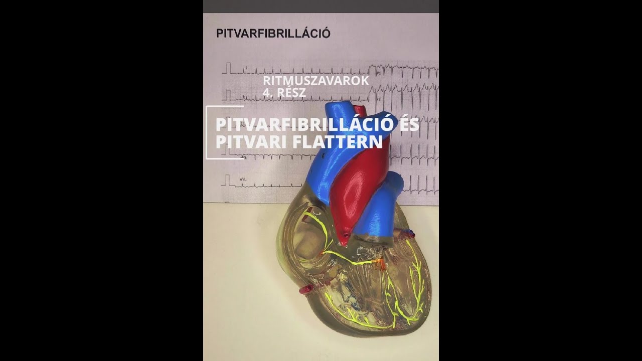Ritmuszavarok 4.rész – Pitvarfibrilláció és Pitvari Flattern