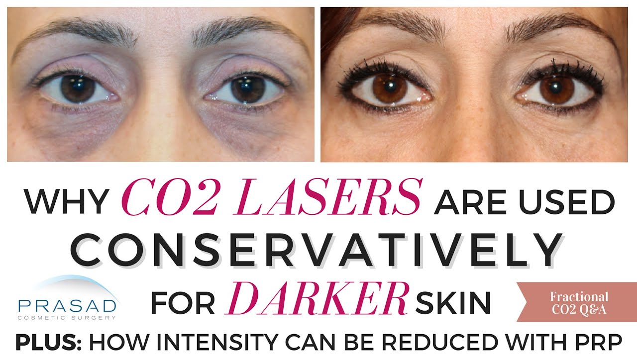 CO2 Lasers Should be Used Conservatively on Dark Skin, and Usually Takes More than One Treatment