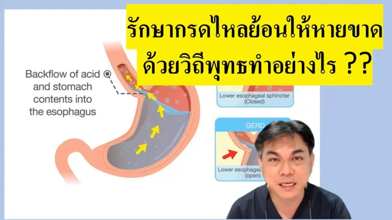 คำถามทางบ้าน : รักษากรดไหลย้อนให้หายขาด ตามอย่างวิถีพุทธ
