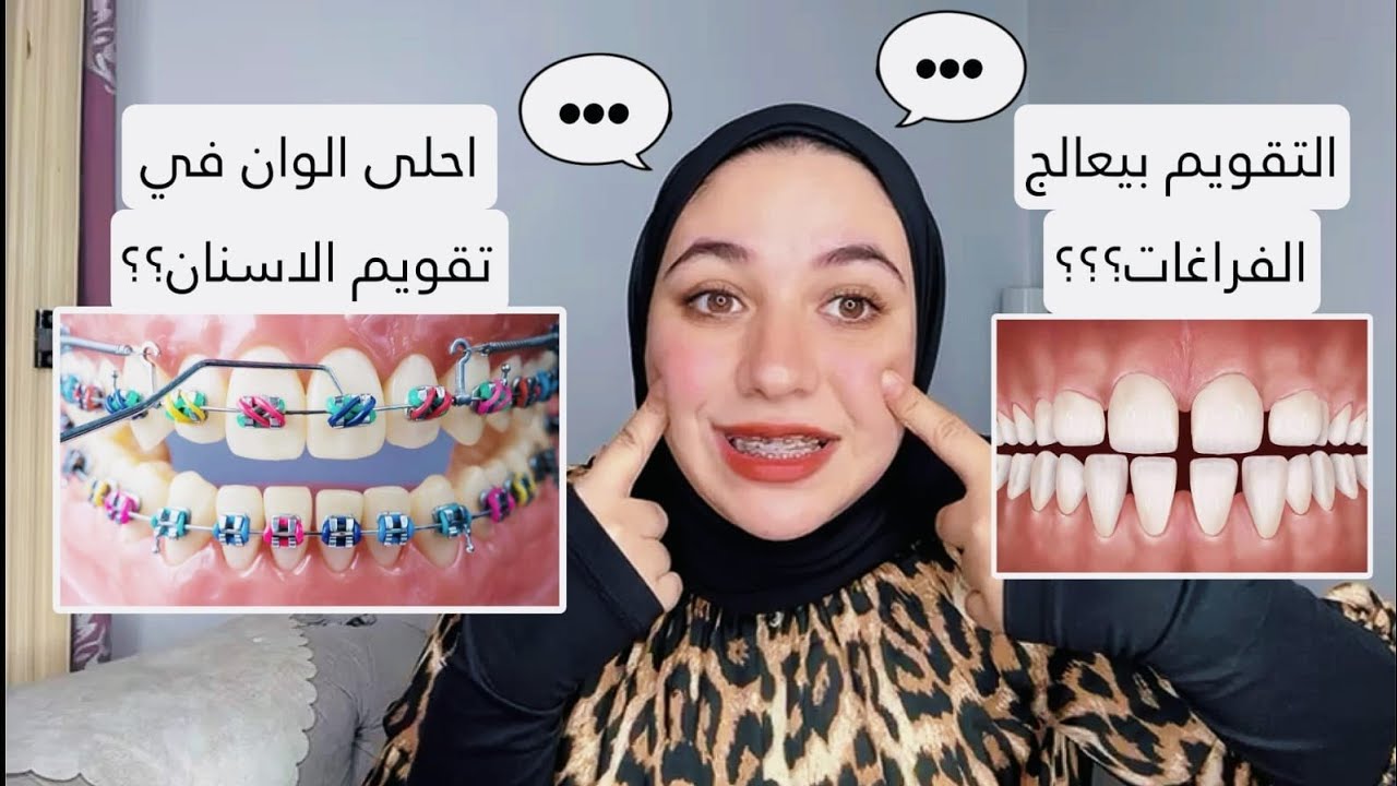 التقويم بيعورني | نتيجة التقويم متأخرة | ألوان التقويم الجميلة | اسئلةعن تقويم الاسنان | الجزء الاول