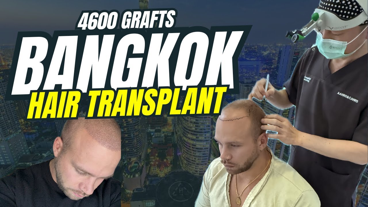 4,600 Grafts in Bangkok: The Hairline I Never Thought I’d Get Back