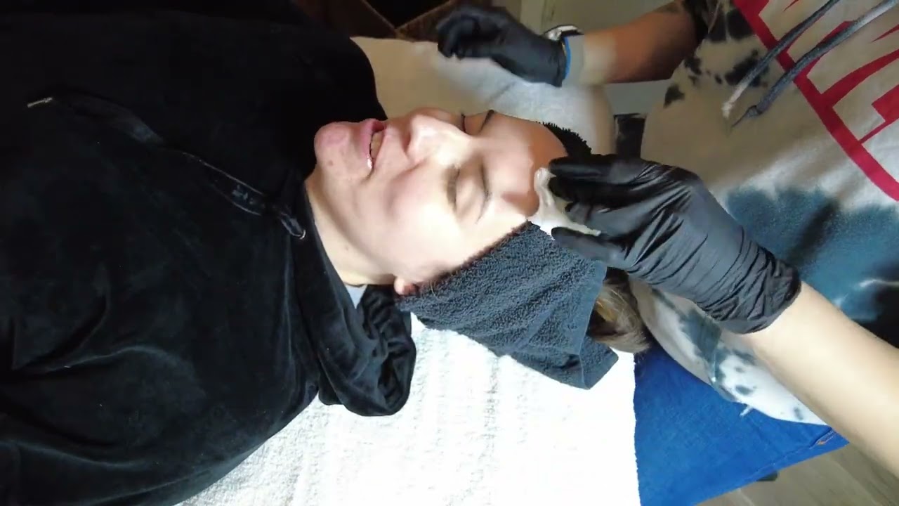 Skin Script TCA Depigmentation Peel at Inner Glow Spa & Wellness