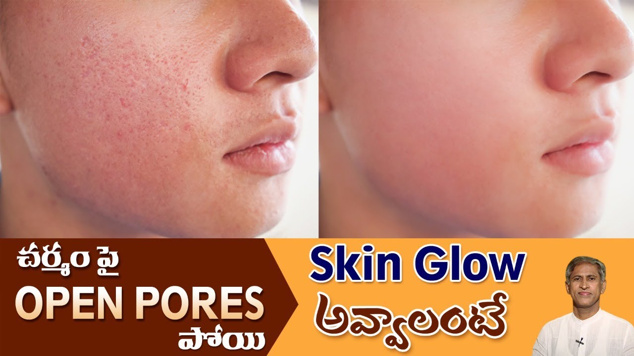 How to Get Rid of Open Pores Naturally | Glowing Skin | Oil Bath | Dr.Manthena's Beauty Tips