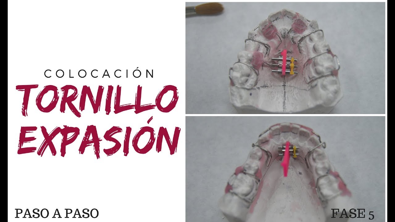 Colocación tornillo de expansión superior e inferior • PLACA DE EXPANSIÓN (5/8).