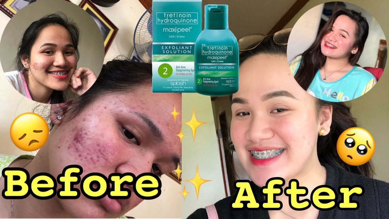 MAXIPEEL EXFOLIANT SOLUTION #2 REVIEW | FADED MY ACNE SCARS AND PIMPLES