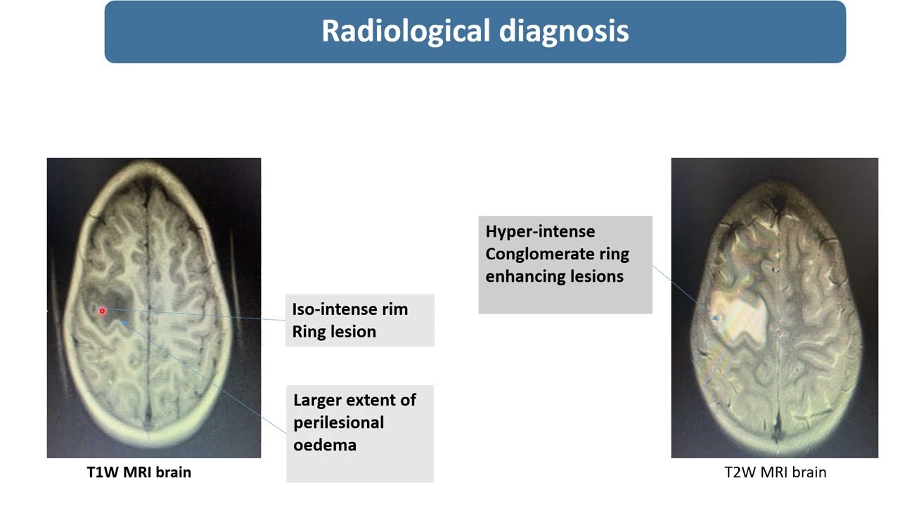 Focal Aware Seizure | Simple Partial Seizure | Tuberculoma | Spot Diagnosis - 13 | Pediatrics
