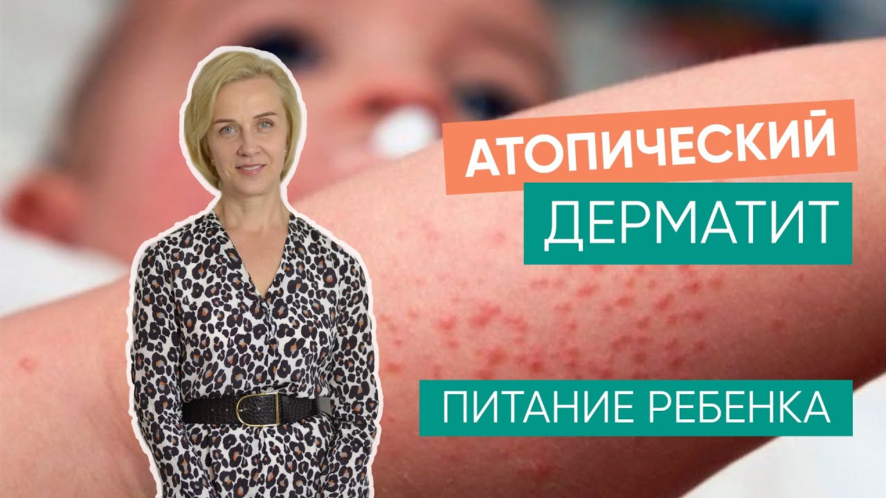 Атопический дерматит и питание ребенка