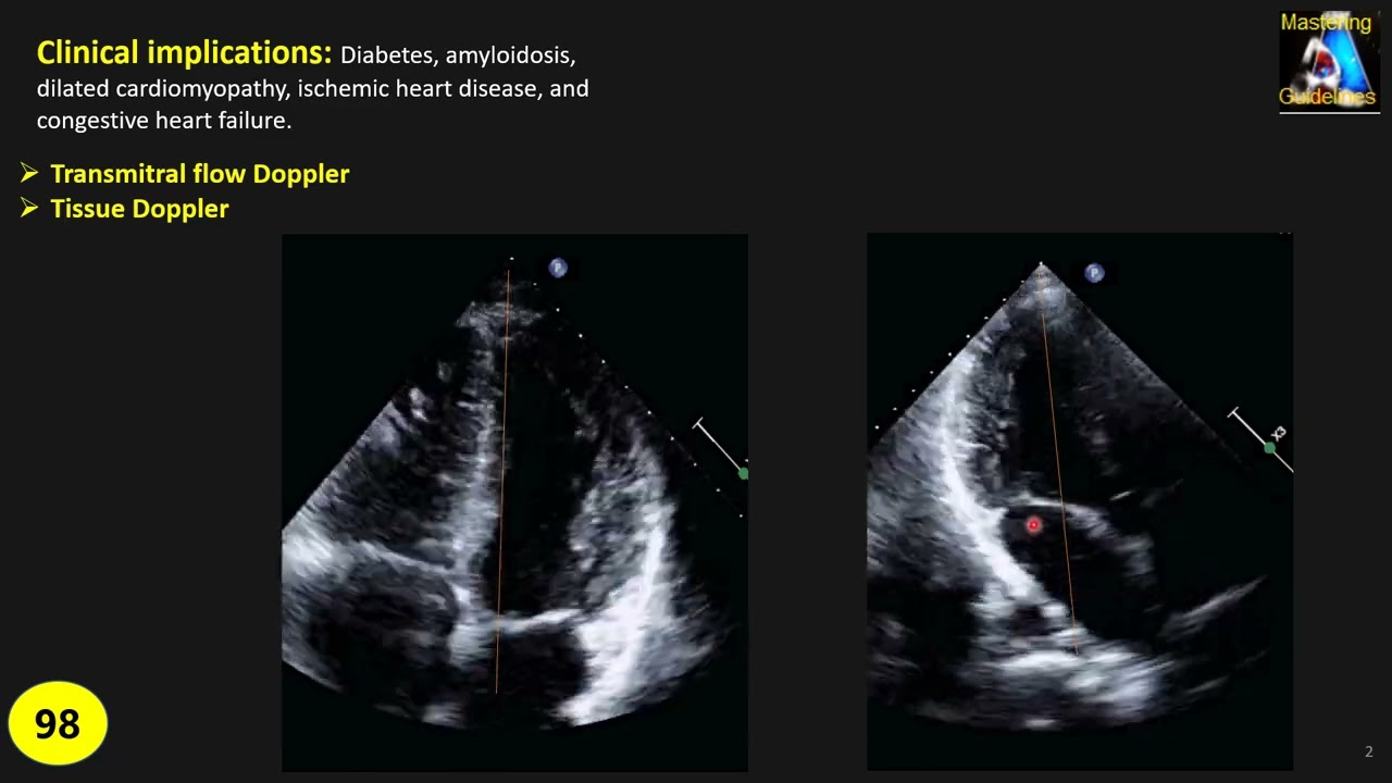 Tips & Mistakes: Tei Index (Myocardial Performance Index)