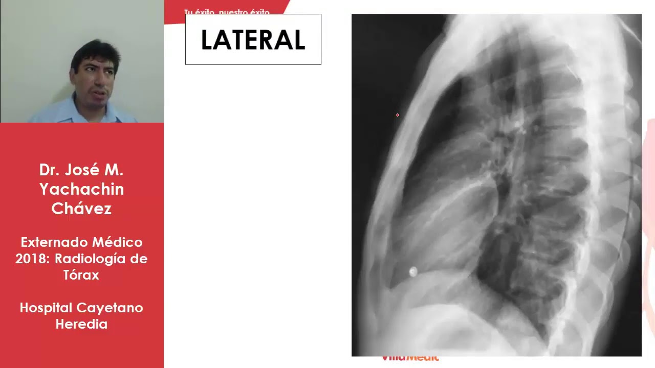 RADIOLOGIA DE TORAX
