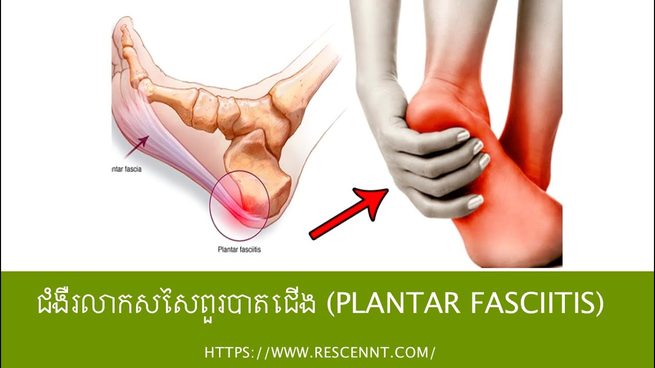 ជំងឺរលាកសសៃពួរបាតជើង Plantar fasciitis