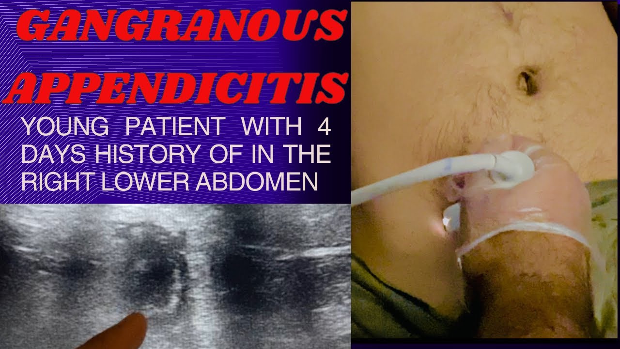 Ultrasound | Gangrenous Appendictis | Acute Appendicitis | ultrasound learning