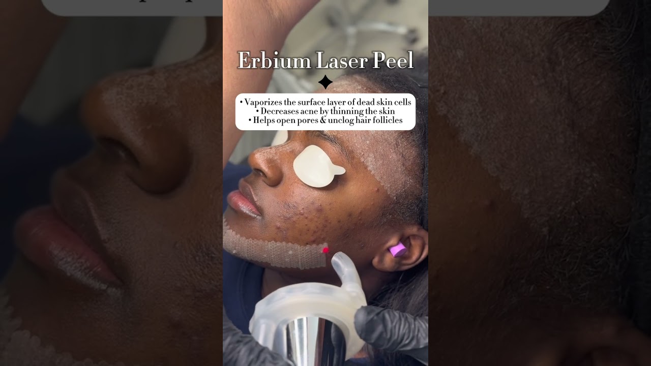 Laser Skin Rejuvenation | Erbium Laser Peel✨