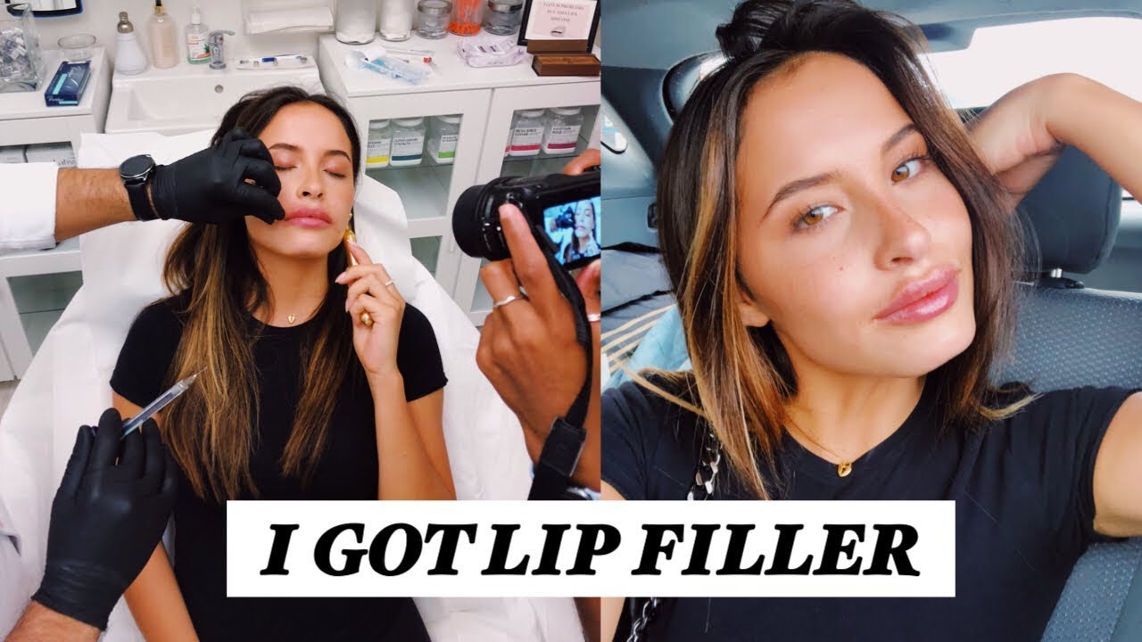 I GOT LIP INJECTIONS- LIP FILLER VLOG