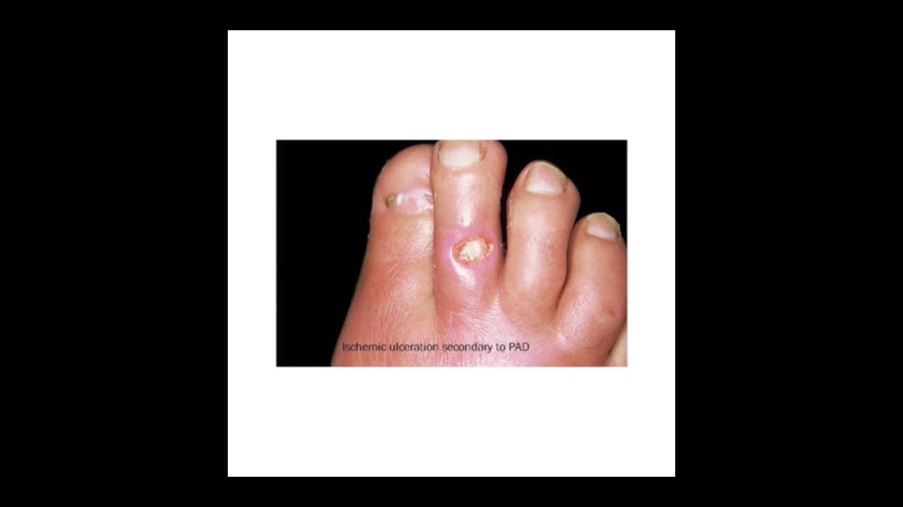 Vascular surgery - peripheral arterial disease