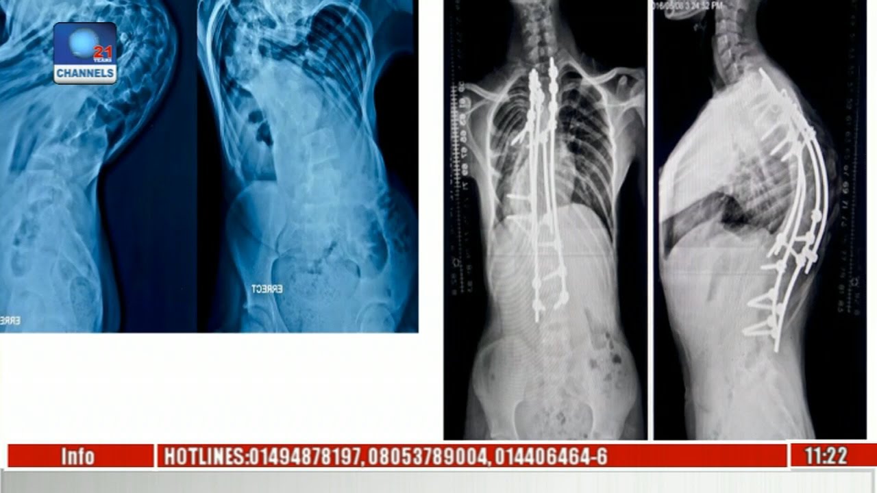 Sunrise: Focos Orthopaedic Hospital; Caring For Africa's Undeserved Population Pt 2