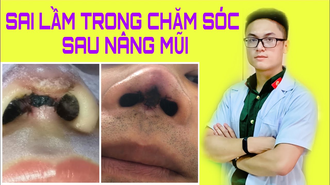 5 Sai Lầm Trong Chăm Sóc Sau Phẫu Thuật Nâng Mũi | Bs Hoàng Long
