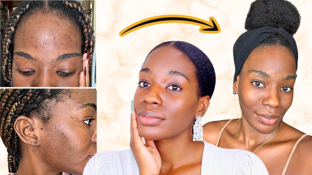MA SOLUTION CONTRE L'ACNÉ ET LES TÂCHES ⎜SKINCARE ROUTINE + MON ÉVOLUTION