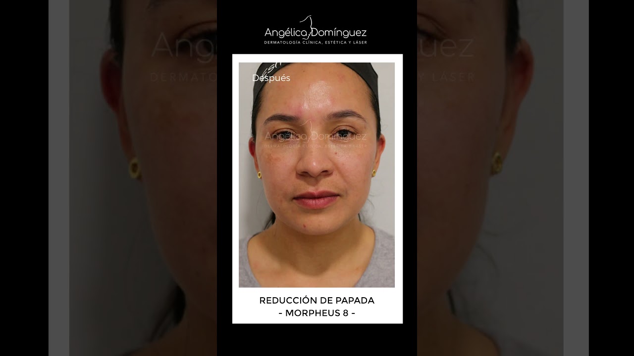 Antes y Despu&eacute;s Eliminaci&oacute;n de Papada - Dr. Ang&eacute;lica Dom&iacute;nguez Dermat&oacute;loga en bogot&aacute; #dermatologo