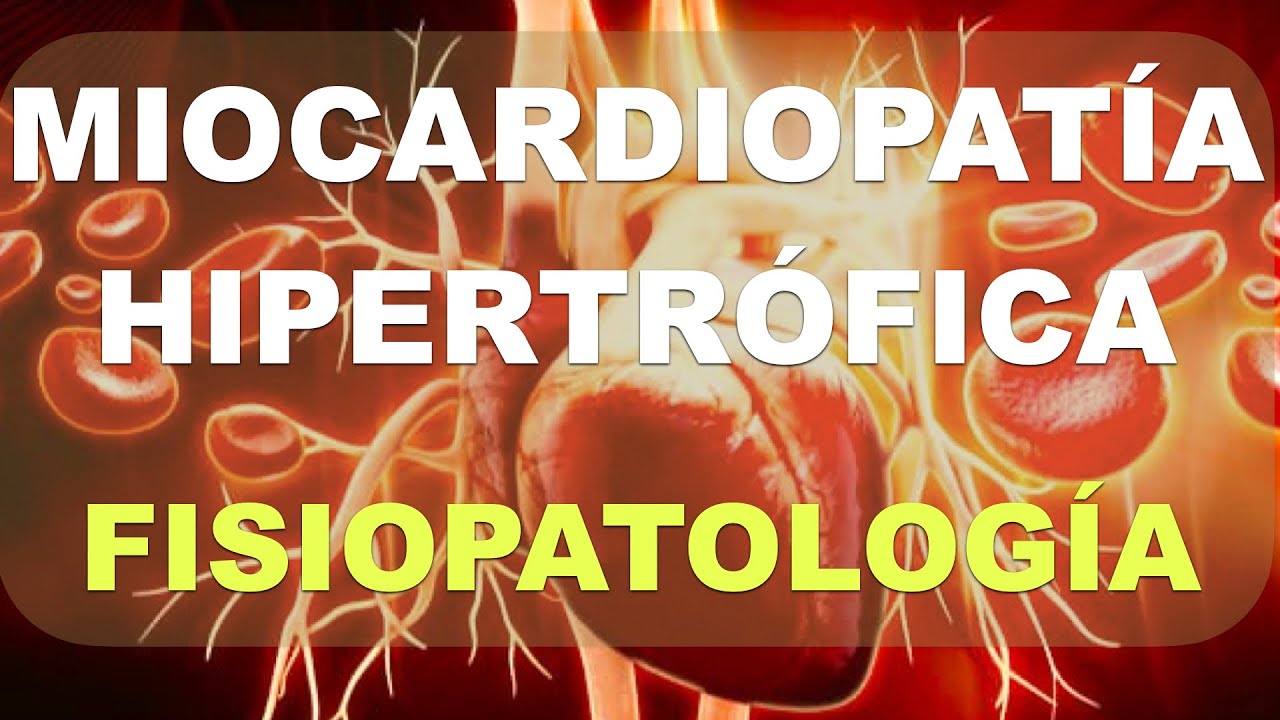 Miocardiopat&iacute;a hipertr&oacute;fica. Fisiopatolog&iacute;a