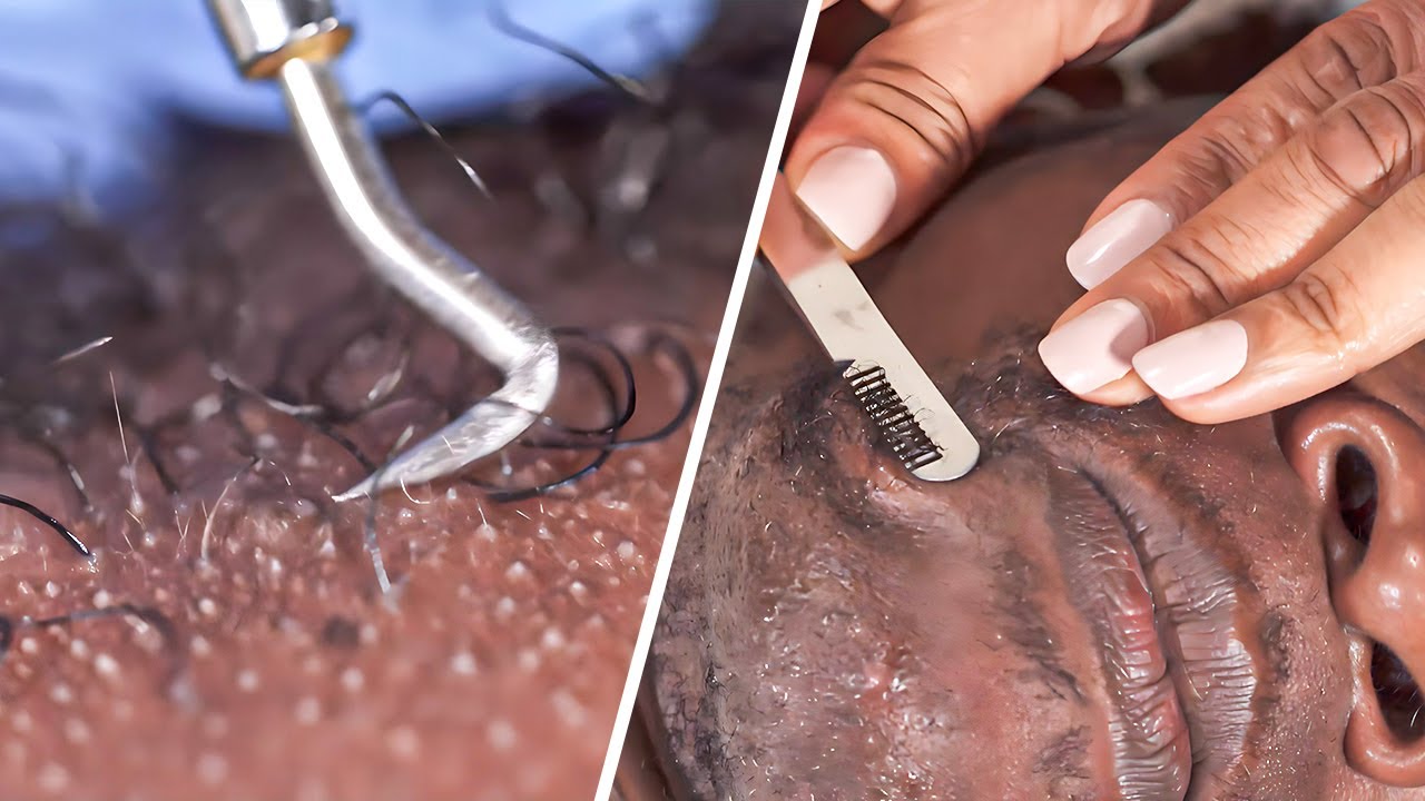 Ingrown Hair Treatment