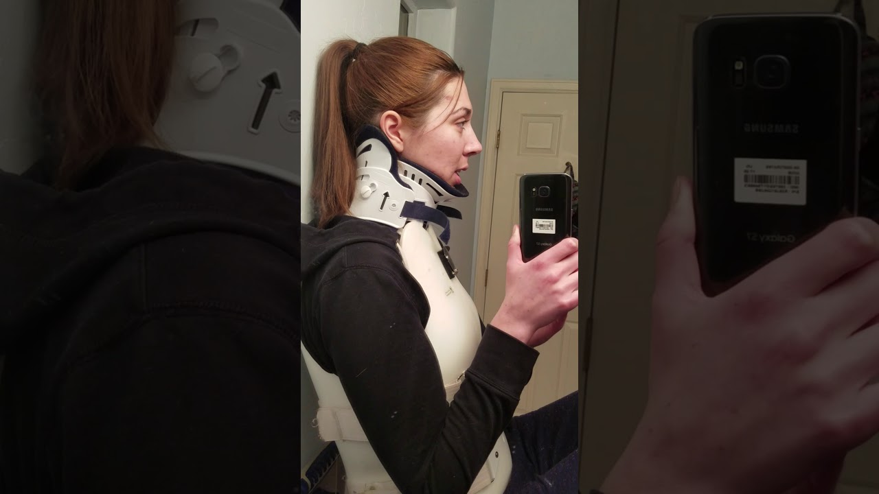 Nonunion Fusion Neck Mobility January 8, 2018
