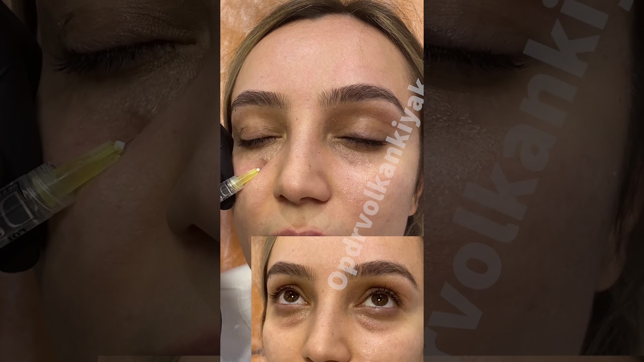 Canlı Canlı Işık Dolgusu 😉