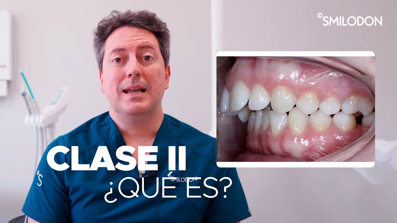 Clase II en Ortodoncia · Qué es, qué problemas de salud  provoca y cómo solucionarlo