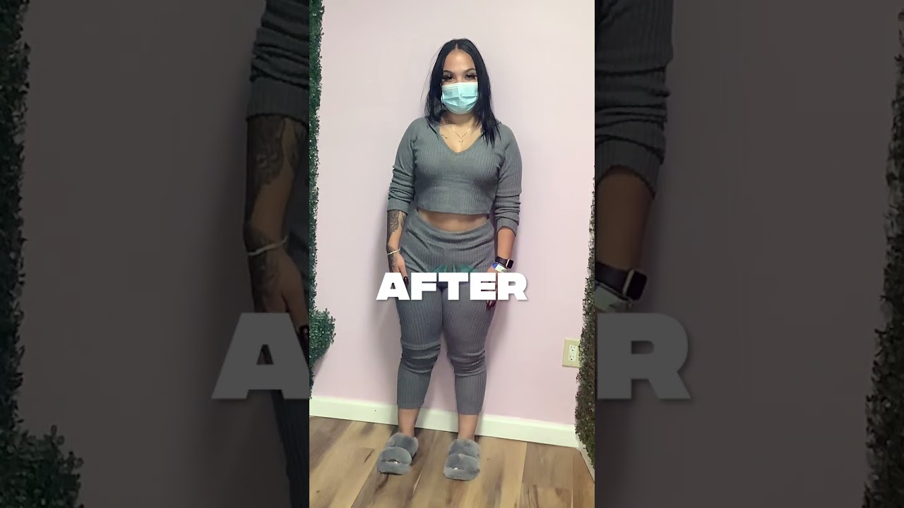 -41 Lbs In 6 Month After Her Orbera Gastric Balloon Procedure 🔥❗️ #nonsurgicalweightloss