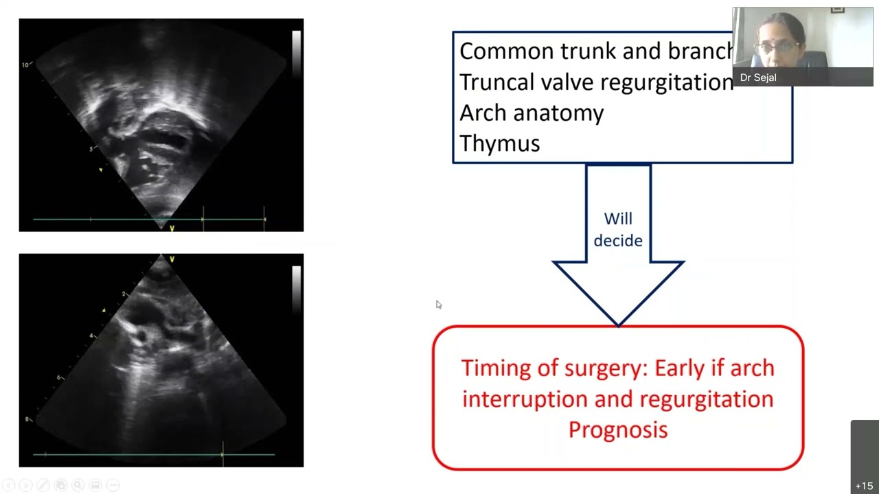 Fetal echo series # 6 Part 2 Anomalies by Dr Sejal Shah