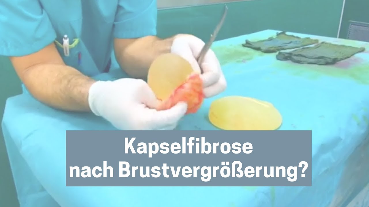 Beauty Insiders: Kapselfibrose nach Brustvergrößerung? | Dr. Benjamin Gehl & Dr. Rolf Bartsch