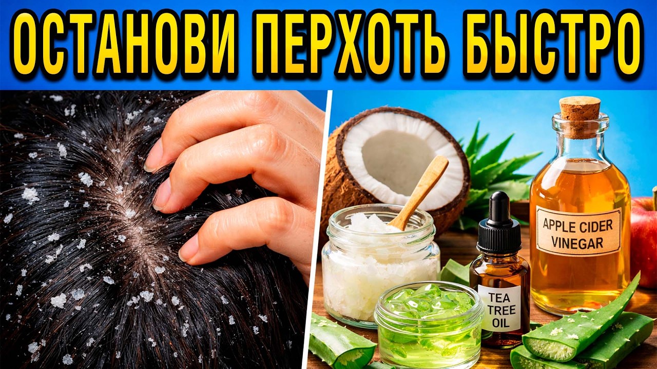 ОСТАНОВИ ПЕРХОТЬ БЫСТРО | Почему чешется кожа головы?