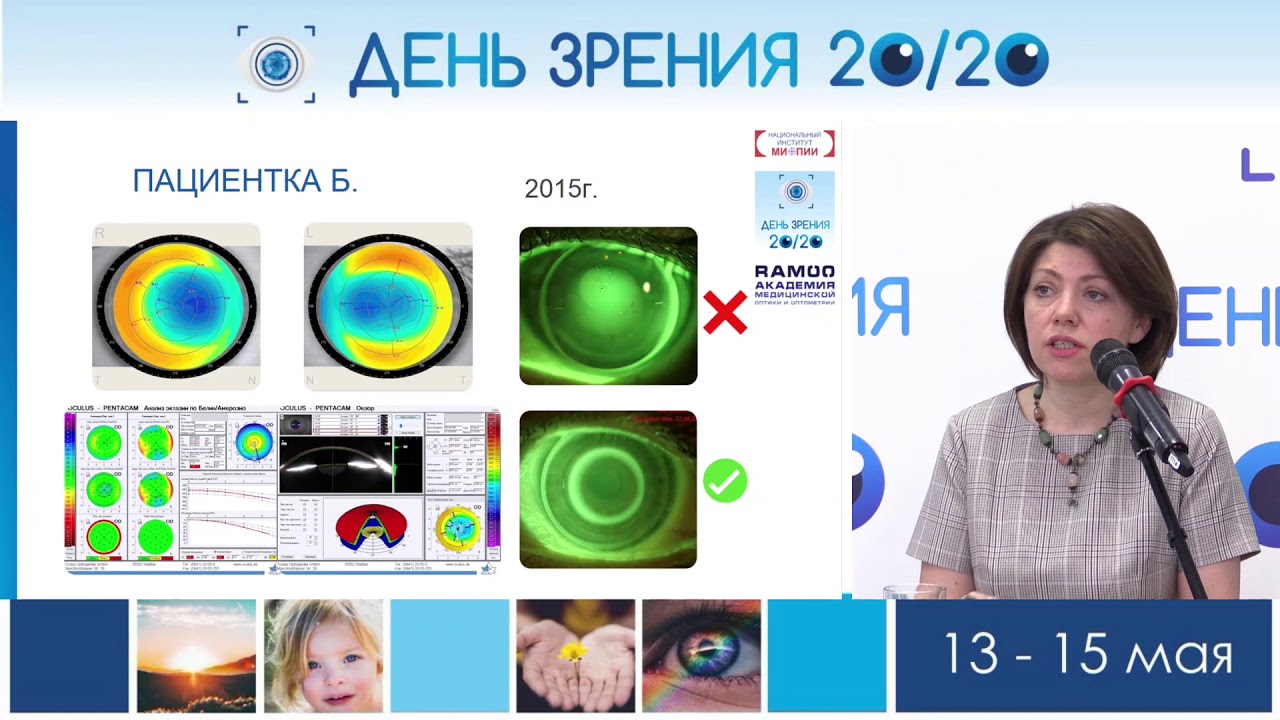 Применение кератотопографа 