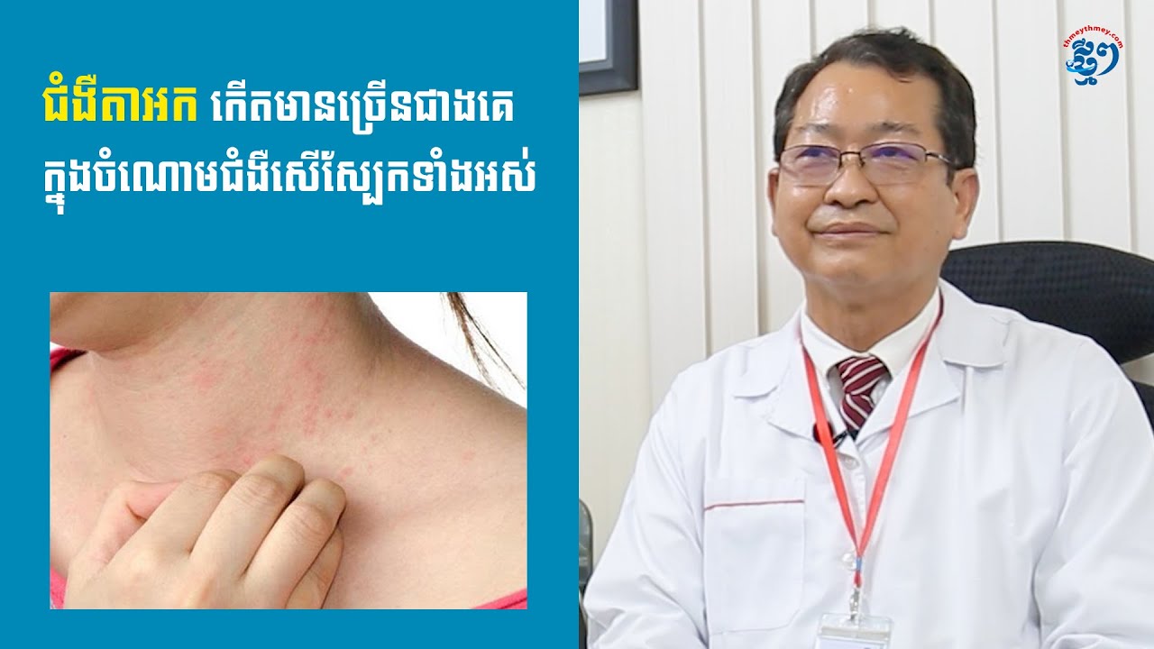 ជំងឺតាអក កើតមានច្រើនជាងគេ ក្នុងចំណោមជំងឺសើស្បែកទាំងអស់