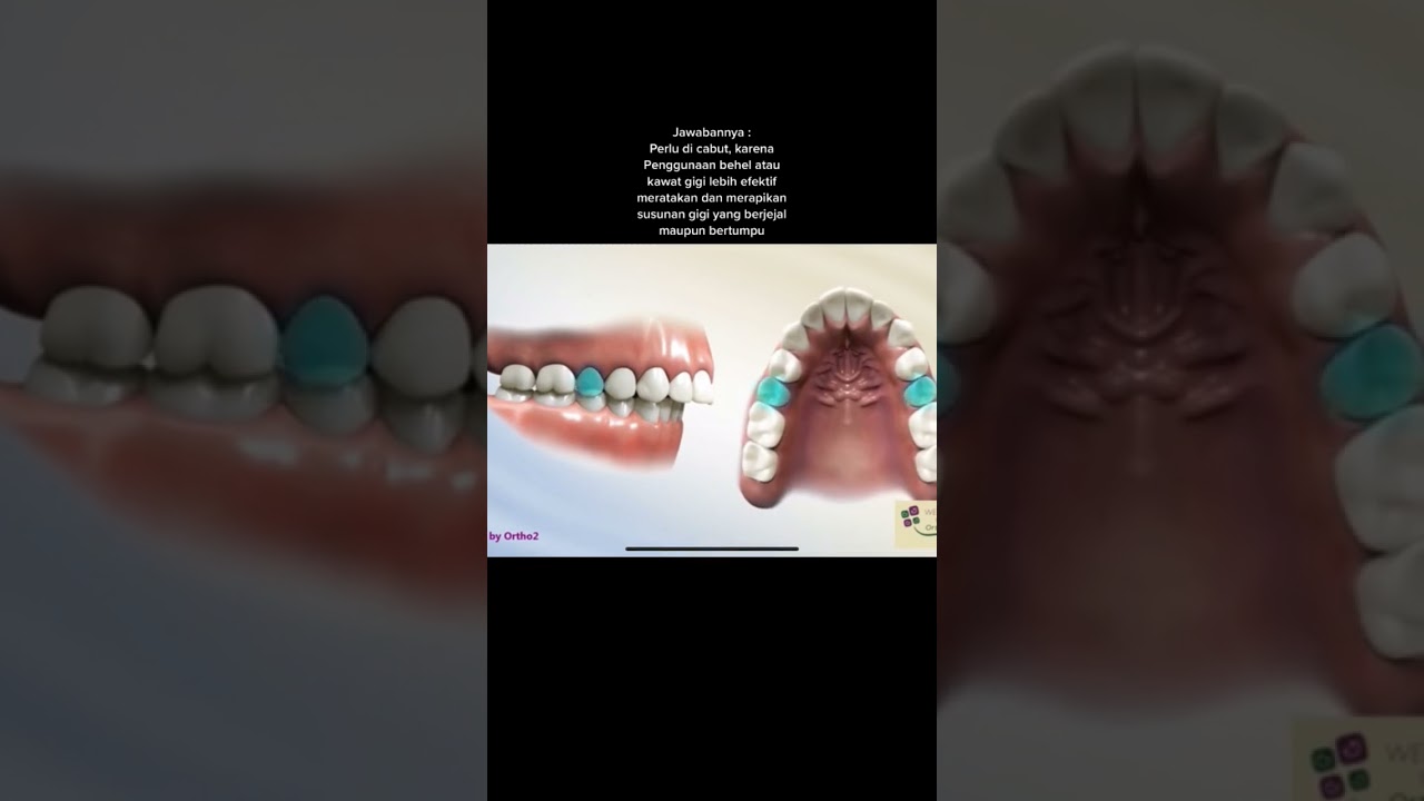 Haruskah cabut gigi sebelum pasang behel?,,,yuk lihat dulu videonya #doktergigi #smilereadybali