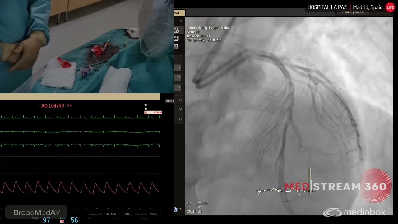 IVUS Guided TCI-DA revascularization