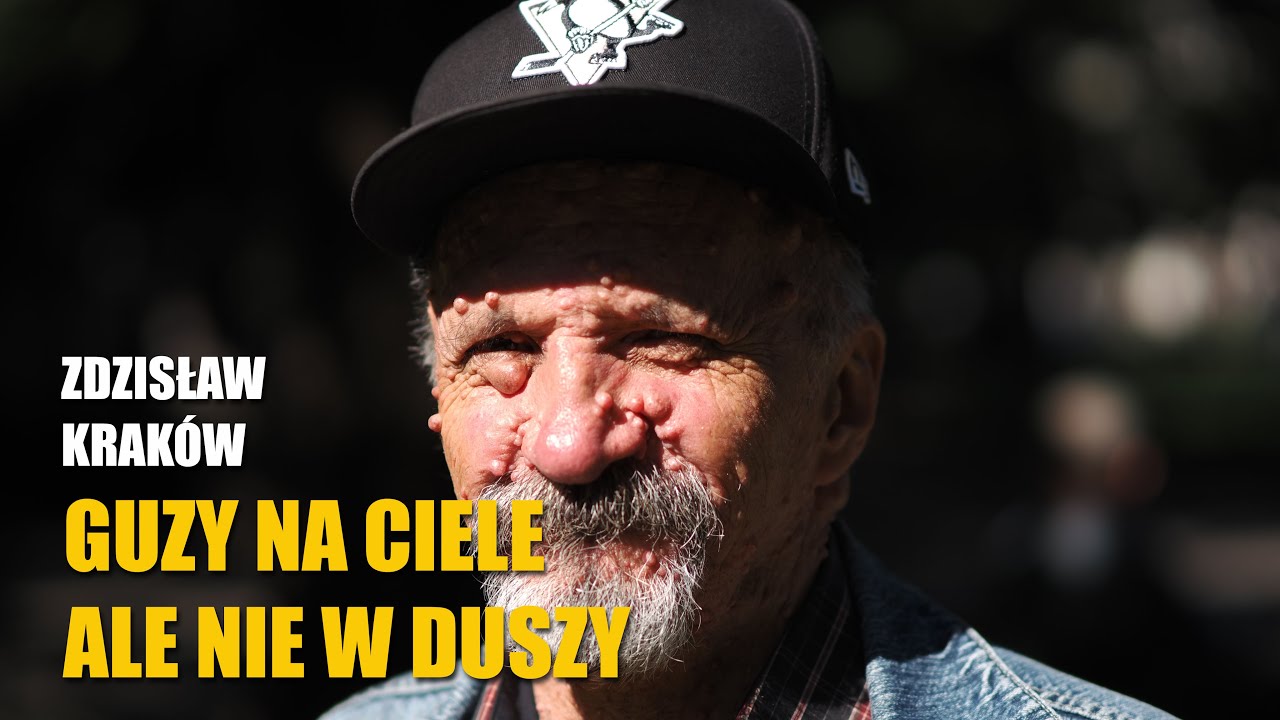 Nie mam do Boga żalu - zespół Recklinghausena