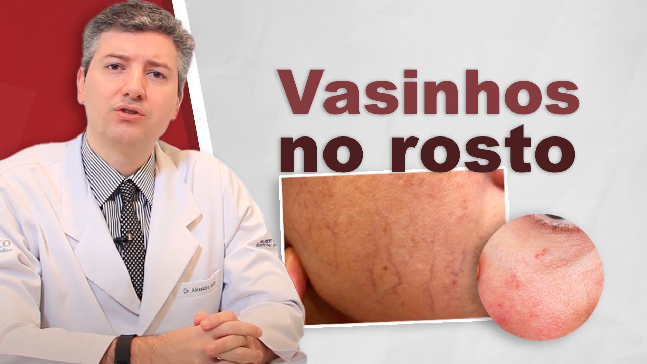 Vasinhos no rosto.Tem como tratar. Laser é melhor.