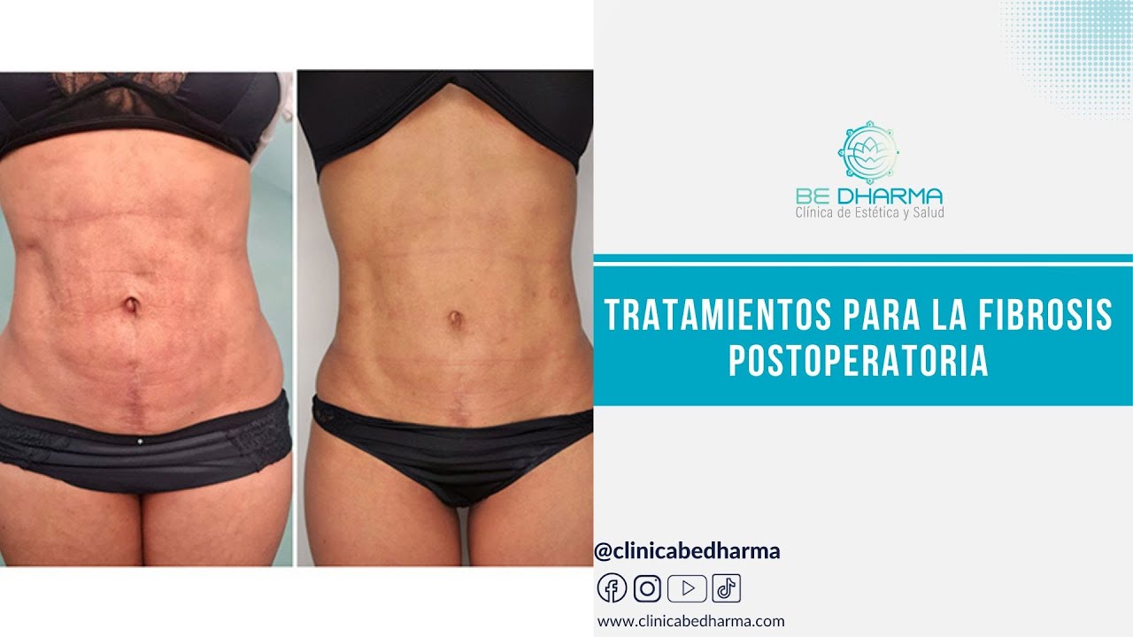 &iquest;Qu&eacute; es la Fibrosis? | Tratamientos para la Fibrosis Posoperatoria | Cl&iacute;nica Est&eacute;tica en Medell&iacute;n