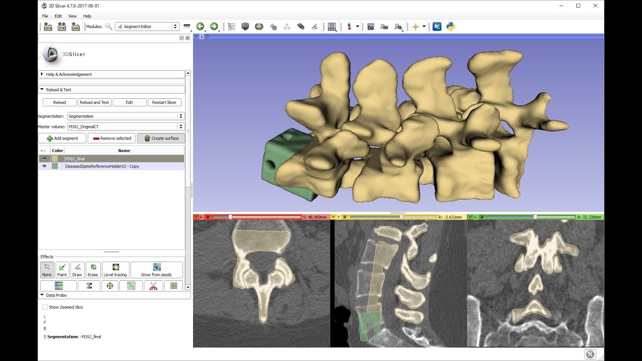 How to segment multiple vertebrae in spine CT for 3D printing