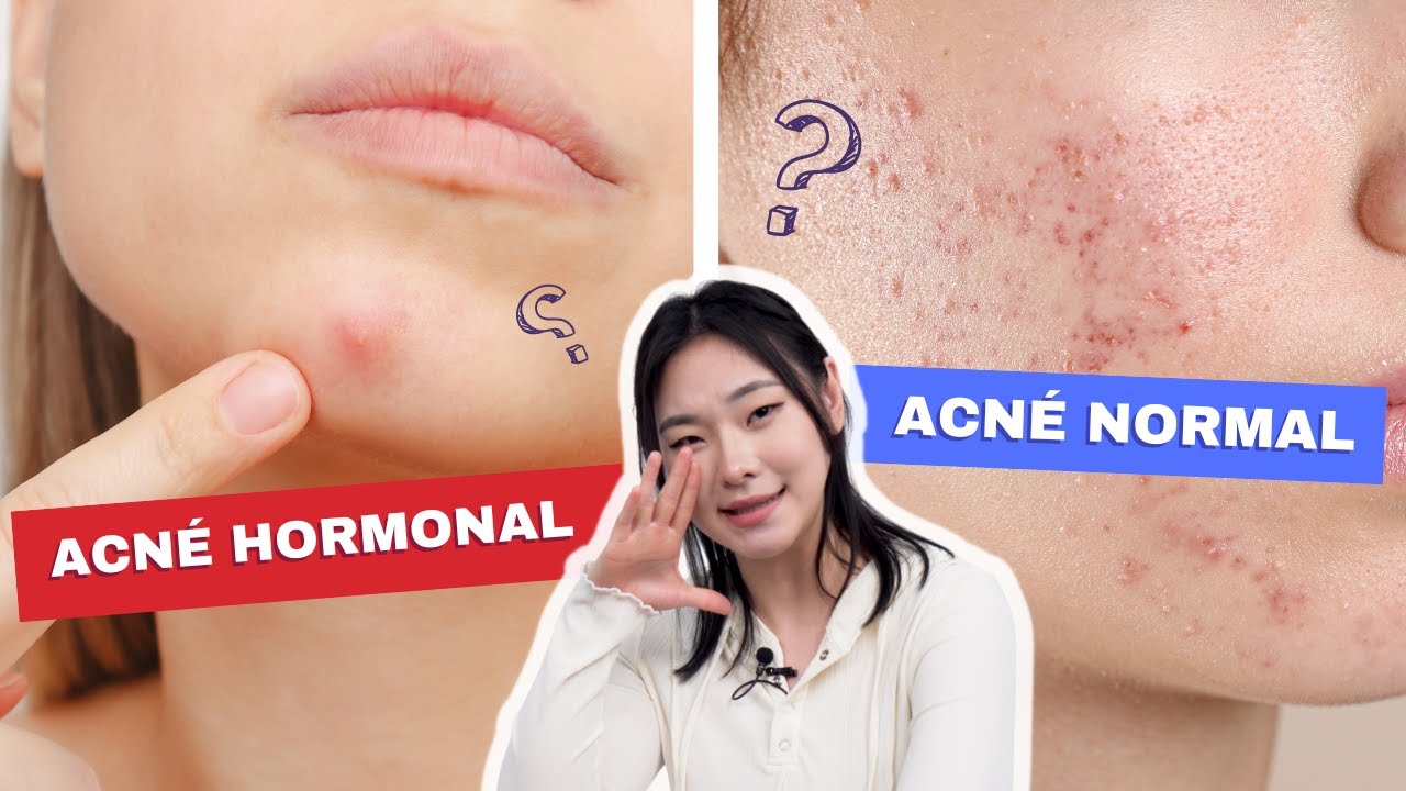 &iquest;ACN&Eacute; HORMONAL VS ACN&Eacute; NORMAL? CAUSAS DE GRANOS Y C&Oacute;MO CURAR EL ACN&Eacute; | UNO, DOS, TRES