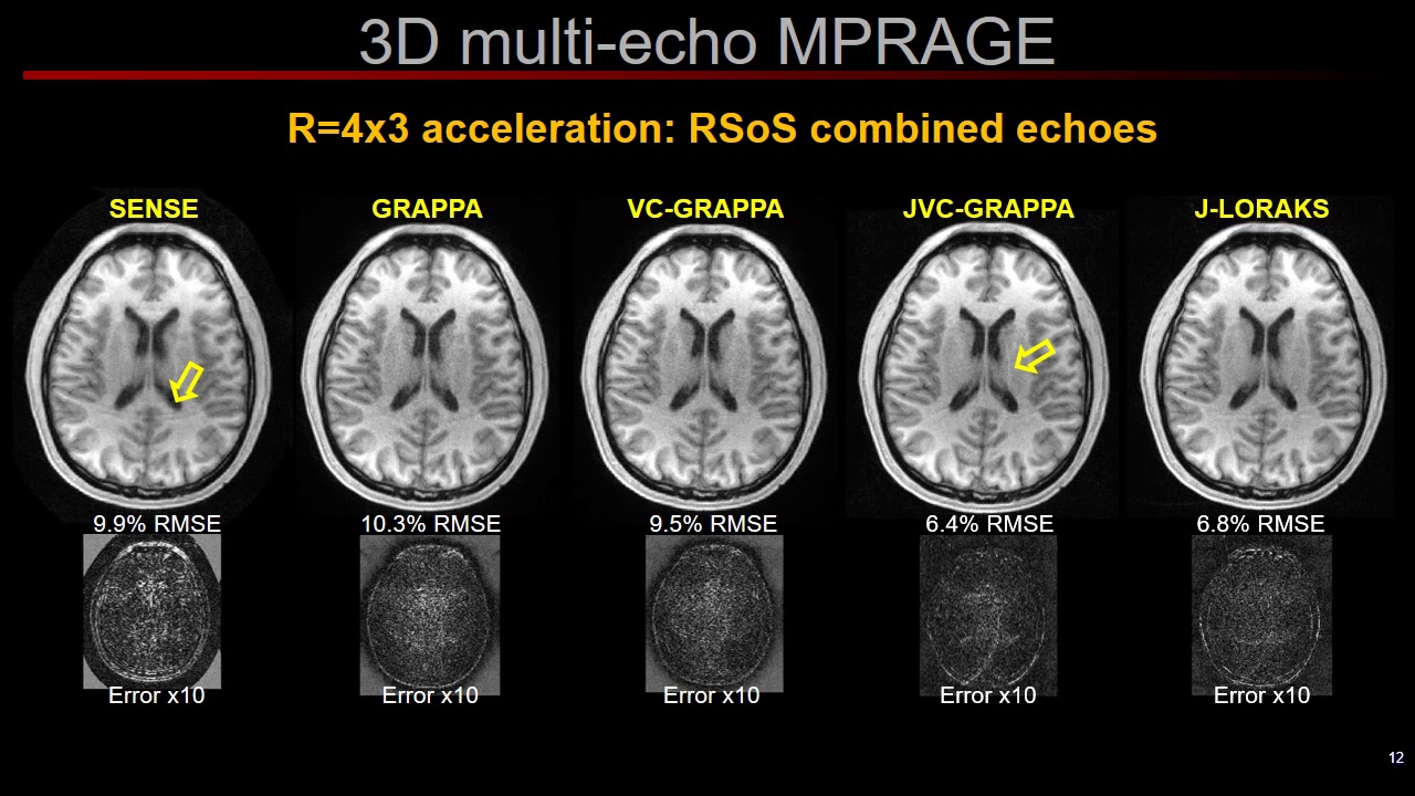 Berkin Bilgic: Improving Parallel Imaging by Jointly Reconstructing Multi-Contrast Data