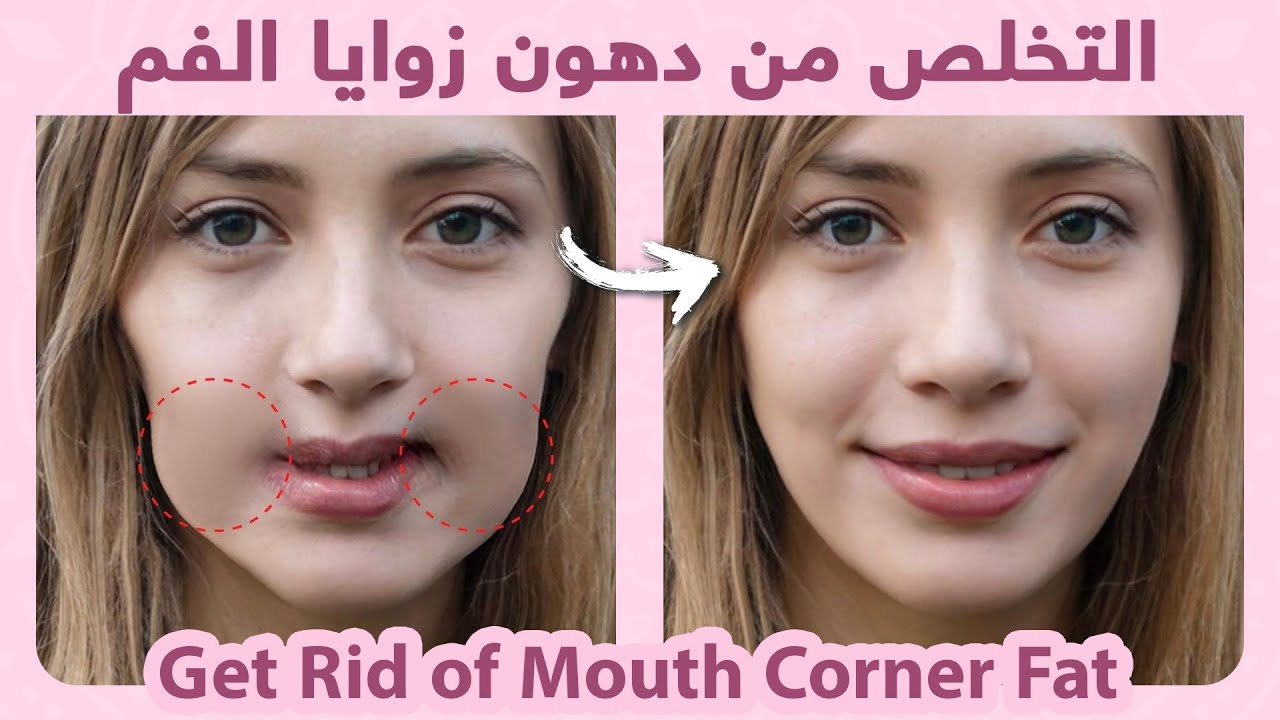 Get Rid of Mouth Corner Fat Naturally |  التخلص من دهون زوايا الفم طبيعياً