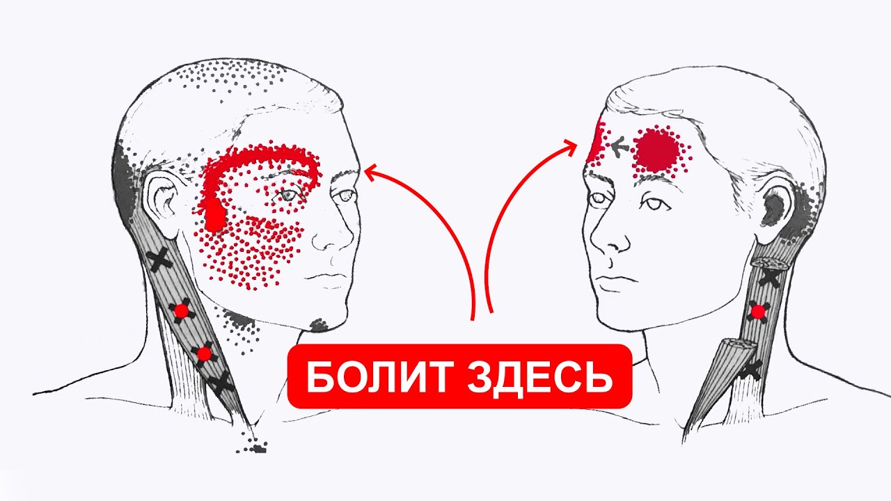 БОЛИТ ГОЛОВА В ЗАТЫЛКЕ И ВО ЛБУ 🔴 ГРУДИНО-КЛЮЧИЧНО-СОСЦЕВИДНАЯ мышца (ГКСМ)