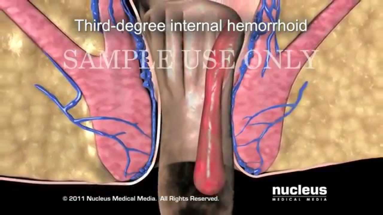 Hemorrhoid Surgery