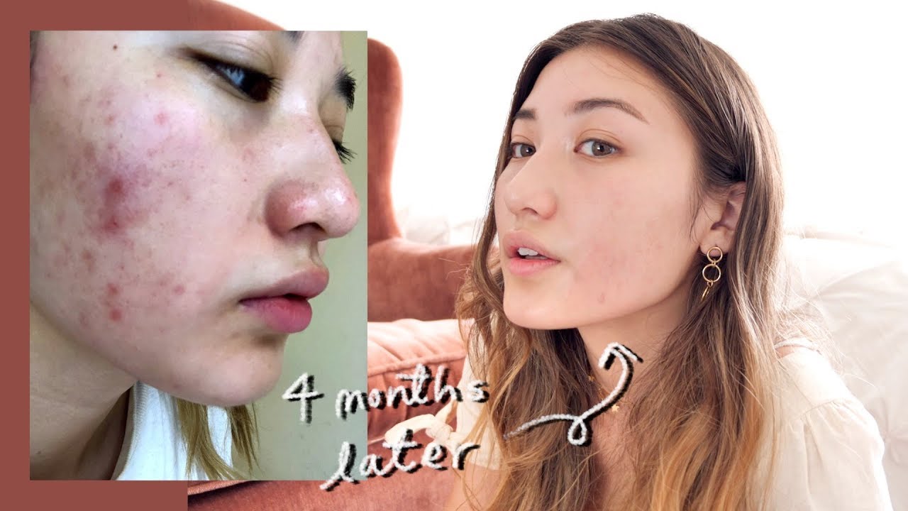 how i (fiNalLY) cleared my skin