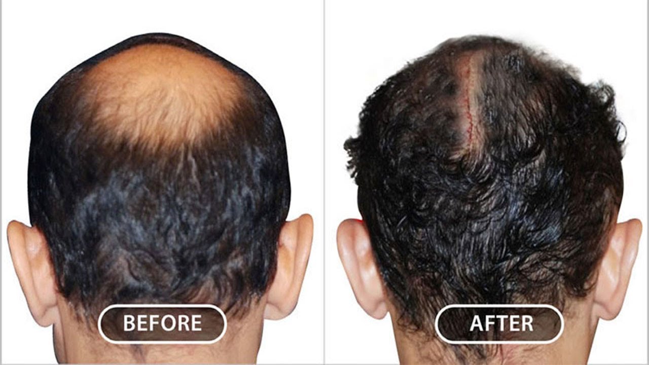 How scalp reduction surgery works to treat hair loss