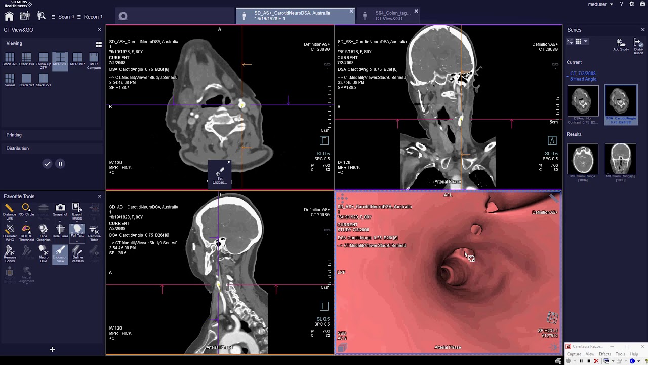 Endoscopic View - طريقه عمل منظار تخيليى على القولون ب الأشعه المقطعيه SIEMENS CT SOMARIS X OR 10