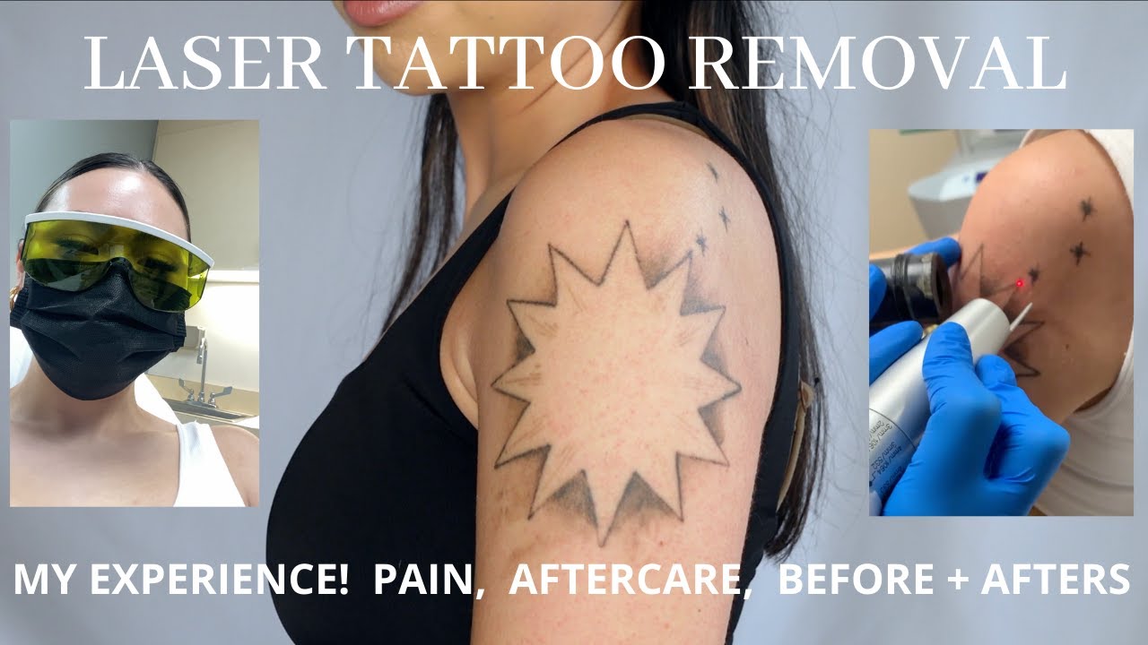 My Laser Tattoo Removal Process w/ Aftercare, Healing, + Before/After