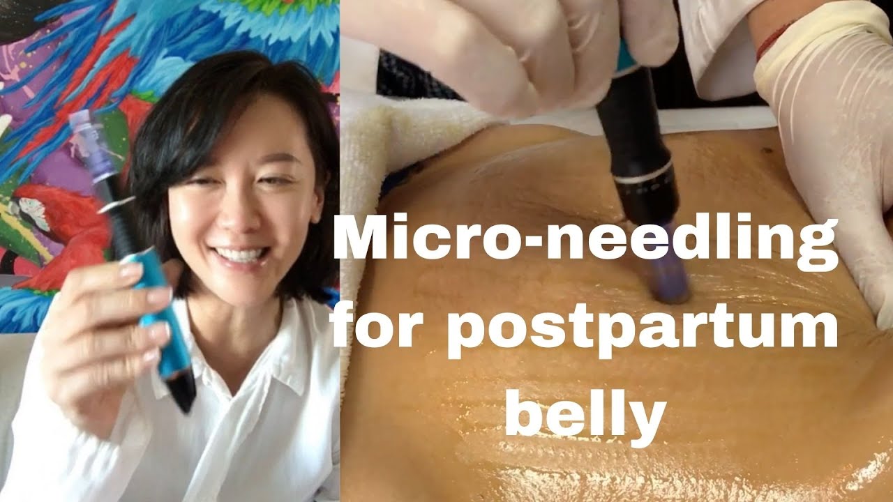 {Master Ruth}Micro-needling for Postpartum Belly - Ep 1